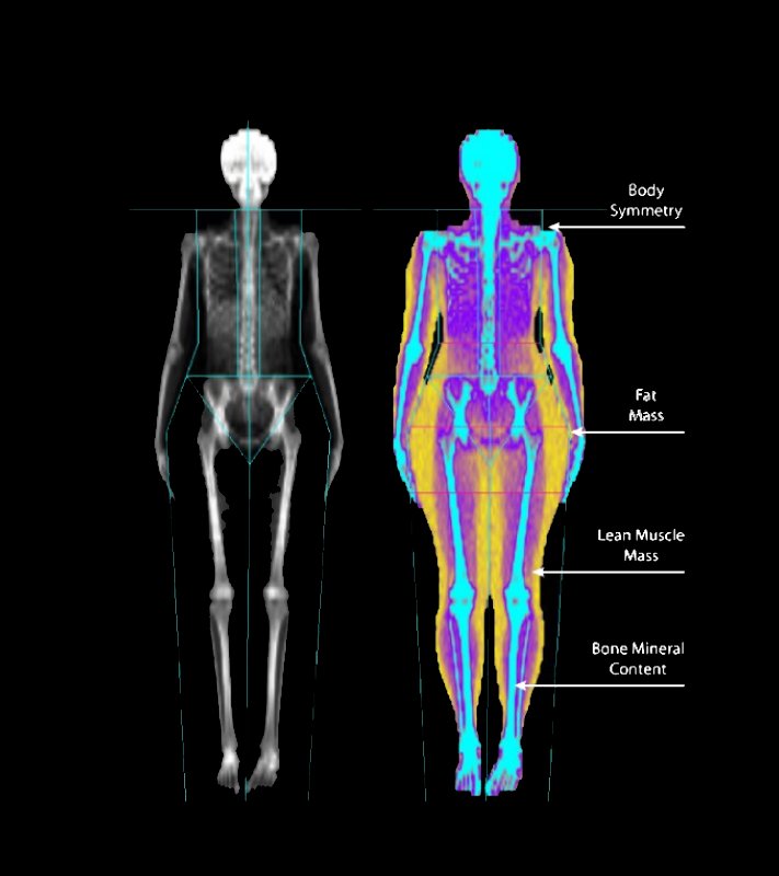 A DEXA scan showing body composition